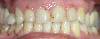 Faccette in ceramica integrale - CLINICA DENTISTICA DI COMO