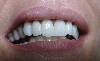 SBIANCAMENTO DENTALE LASER - CLINICA DENTISTICA DI COMO